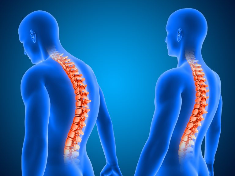 Scolioses idiopathiques: une cause musculaire?