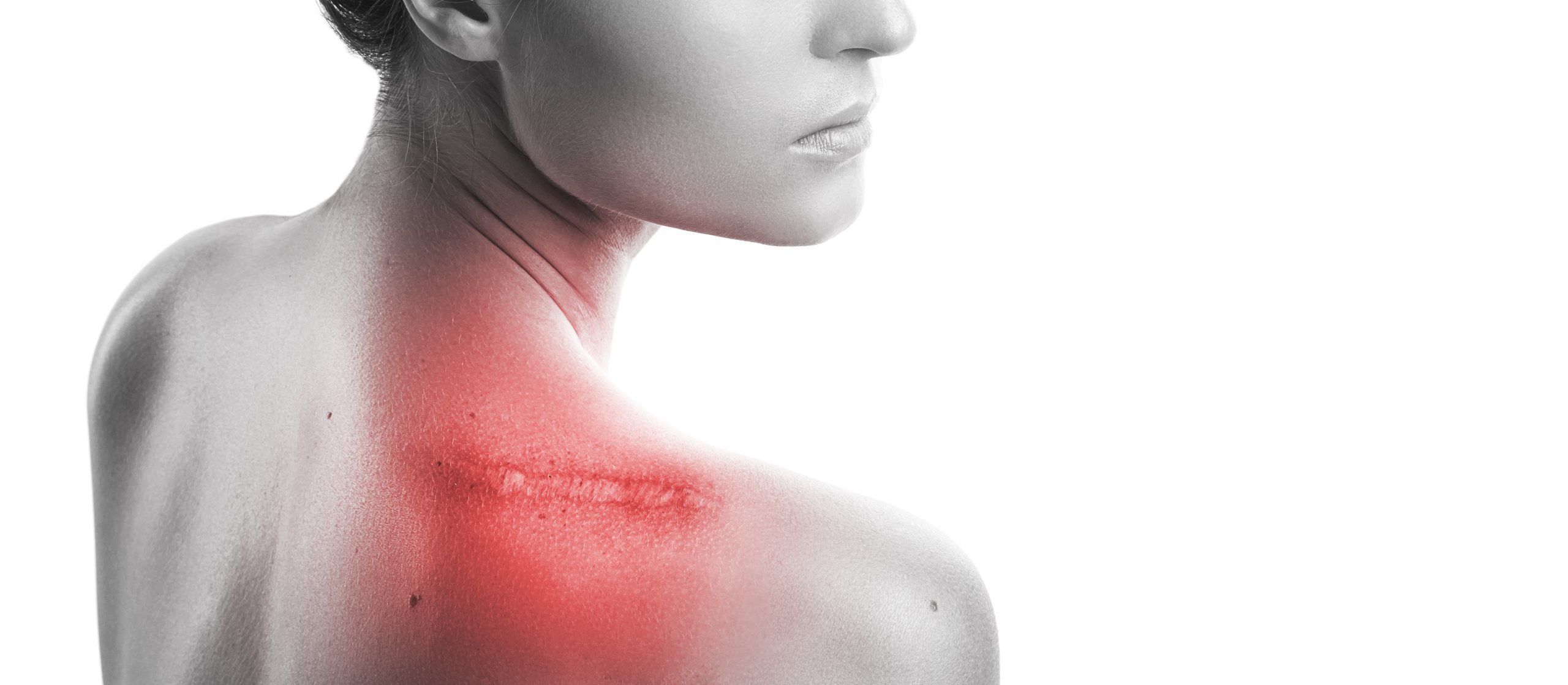 "Les Contractures Post-Traumatiques : Une Hypertonicité Musculaire Énigmatique dans la Fibromyalgie
