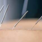 Dry needling acupuncture needles used by acupuncturist physiotherapist on patient in pain and injury treatment, close up macro photo.