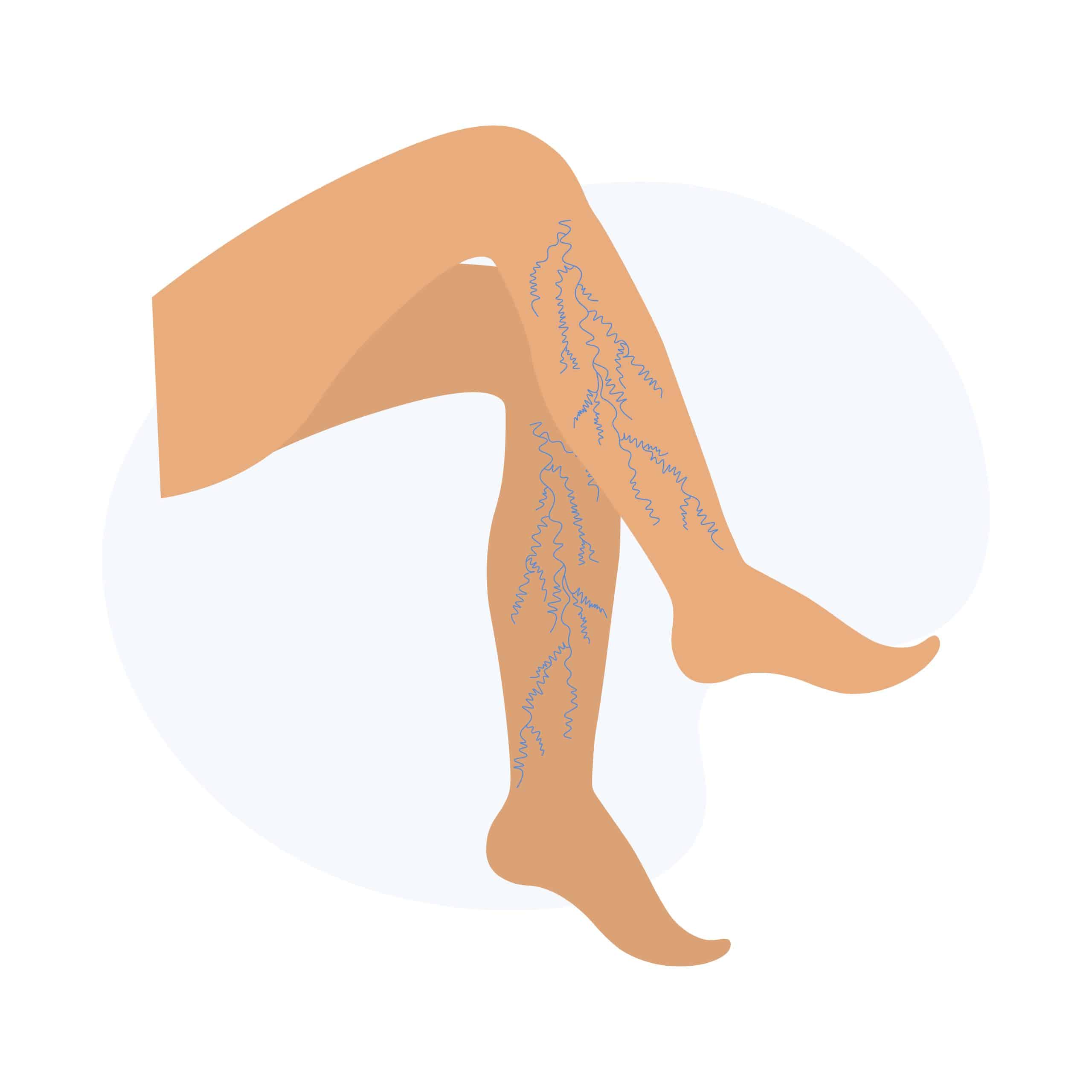 Illustration médicale représentant la sensation de jambes lourdes et les traitements associés.