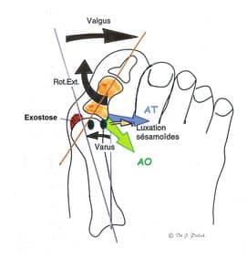 Illustration de l'approche spécifique de la myothérapie pour traiter l'hallux valgus en ciblant les contractures musculaires.