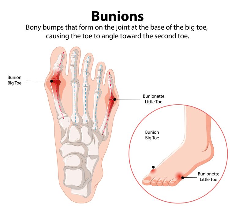 Illustration : Hallux Valgus.