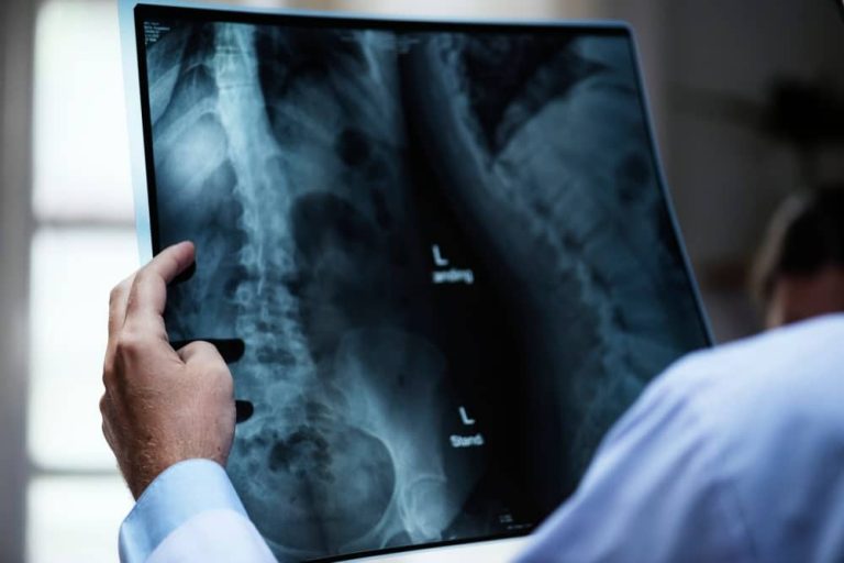 Scoliose idiopathique : le rôle méconnu des causes musculaires