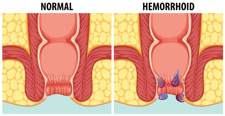 Les résultats de 39 cas traités par myothérapie suggèrent une origine musculaire des hémorroïdes. Le spasme du muscle releveur de l'anus (Levator Ani) pourrait entraîner une augmentation du tonus du sphincter anal et de la pression dans les coussinets hémorroïdaires, contribuant ainsi aux crises hémorroïdaires et à leurs complications telles que la thrombose, les saignements et le prolapsus.